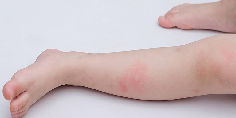 Muỗi có thể truyền bệnh sốt rét