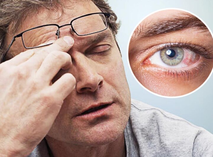 Khô mắt - triệu chứng thường gặp gây khó chịu cho người già